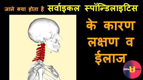 cervical spondylosis in hindi